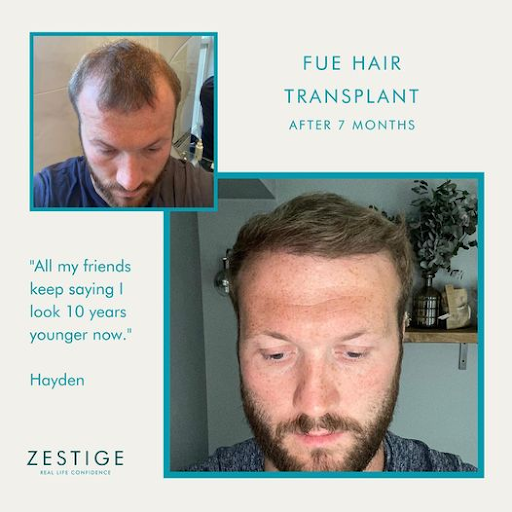 FUE hair transplant london